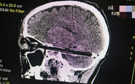 Məhkumun beynindən qələm ÇIXARILDI